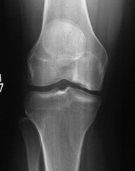 Osteochondral Allograft Pre